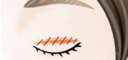 范希玲扇形雙眼皮