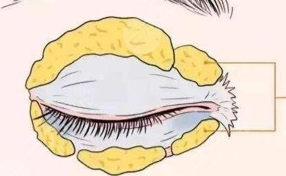 趙穆欣做雙眼皮案例