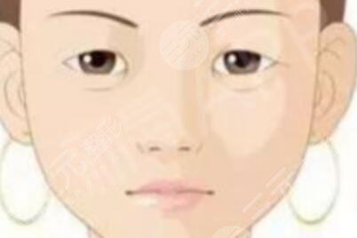 開內(nèi)眼角手術(shù)恢復(fù)圖片