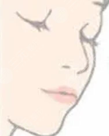 厚唇改薄七天恢復(fù)圖