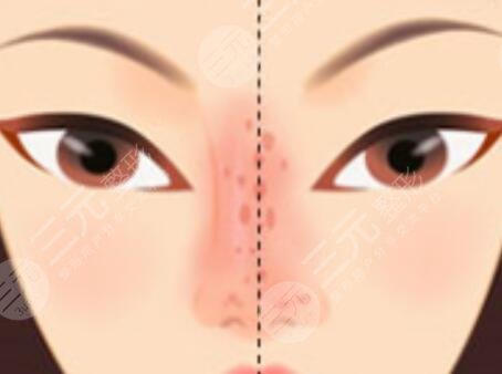 鼻骨內(nèi)推前后對(duì)比照