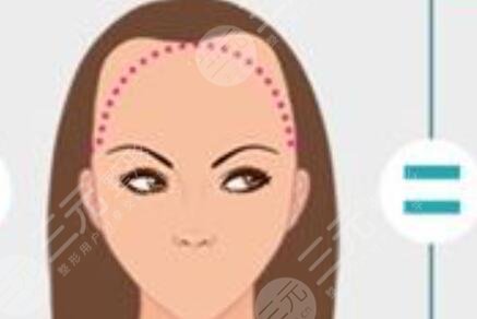 徐州雍禾植發(fā)醫(yī)院發(fā)際線種植手術(shù)案例分享