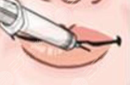 m唇手術對比照|真人微笑唇案例果分享!附唇部整形價格表