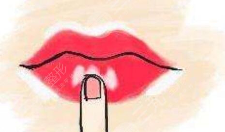 m唇手術真人案例分享