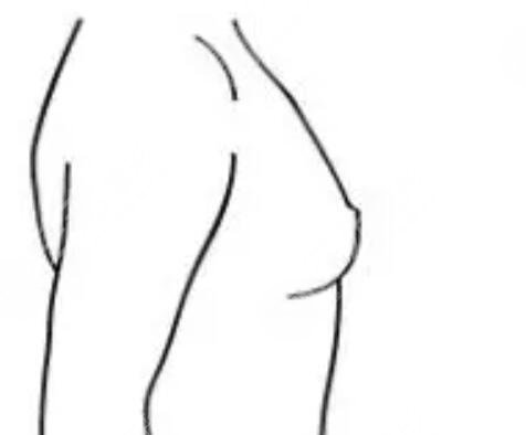 假體隆胸400cc多大