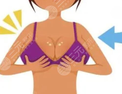 假體隆胸400cc多大