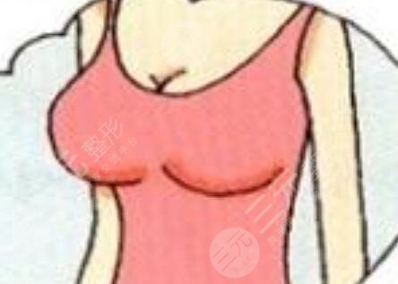 隆胸手術(shù)前后照片