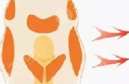 下巴打玻尿酸的后遺癥有哪些？真實(shí)案例果反饋