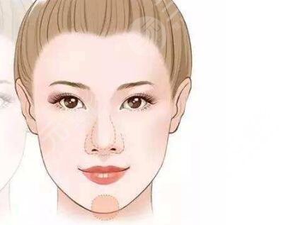 下巴打玻尿酸的后遺癥有哪些?