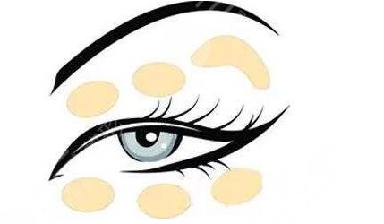 雙眼皮20天恢復圖