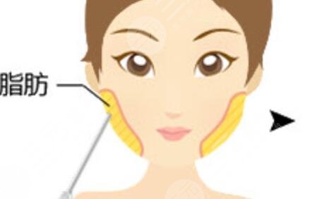 雙下巴抽脂術(shù)案例術(shù)后