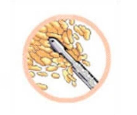 火鳳凰面部溶脂日記：跟煩人肉肉臉說(shuō)byebye~