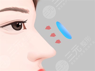 隆肋骨鼻子20天恢復(fù)圖