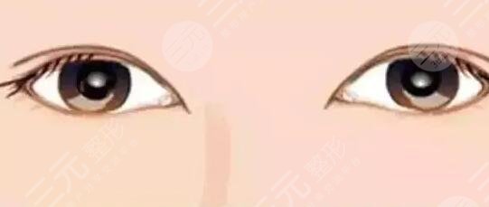 北京同仁醫(yī)院孫強雙眼皮果怎么樣？醫(yī)生技術(shù)測評|雙眼皮案例