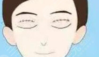 華西卿勇整形失敗雙眼皮修復之前