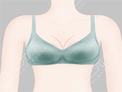 術(shù)前胸部扁平不好看