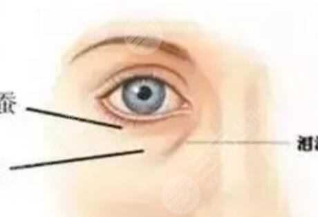 去眼袋果怎么樣？看一下眼袋手術(shù)1-10天圖片