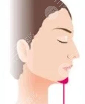 四川嬌點姜宇綠下頜角截骨怎么樣？手術(shù)過程恢復(fù)記錄！