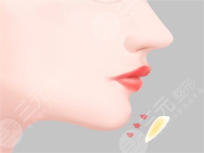 四川嬌點姜宇綠下頜角截骨手術(shù)之后的一個月