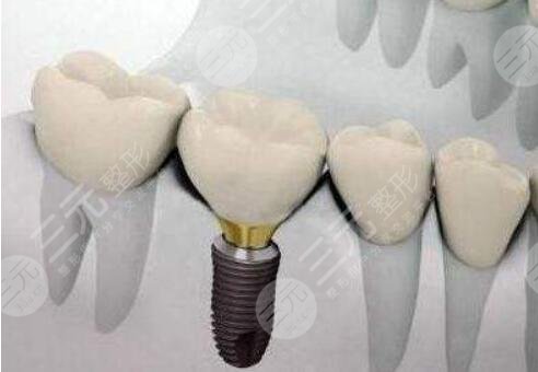 種植牙隨訪(fǎng)時(shí)間