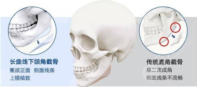 磨骨瘦臉術(shù)后護(hù)理：
