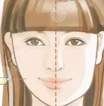 上海九慕整形美容割雙眼皮前