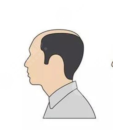 湖北植發(fā)醫(yī)院三甲專家