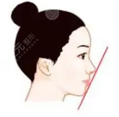 上海九院駝峰鼻矯正案例