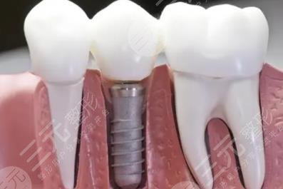 牙齒種植