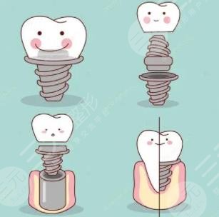 牙齒種植