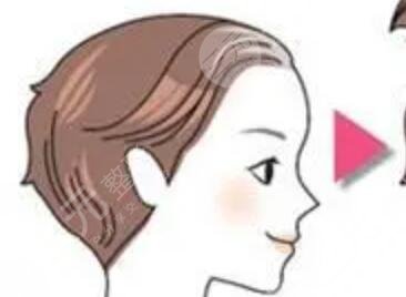 山西大同有沒有植發(fā)