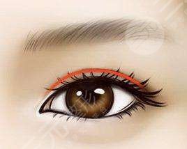 雙眼皮手術(shù)后22天