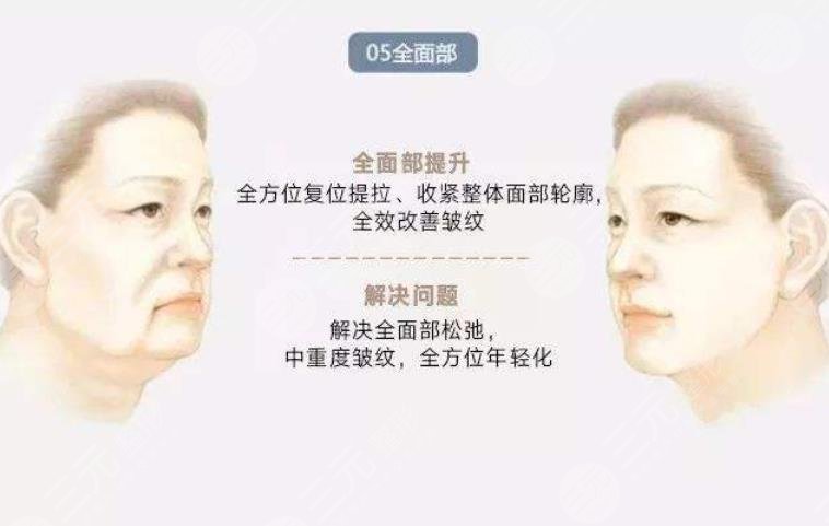 穆寶安v美減齡能保持多久?10年?術(shù)前準(zhǔn)備+術(shù)后護(hù)理盤點(diǎn)!