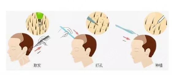 上海九院植發(fā)中心頭頂植發(fā)經(jīng)歷分享