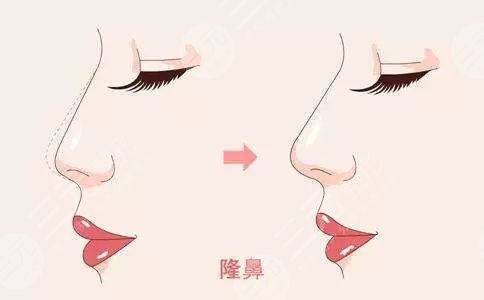 杭州隆鼻專家前十名紅榜揭曉，網(wǎng)友說找這10位做準(zhǔn)沒錯(cuò)的...