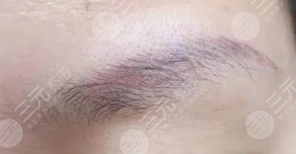 激光洗眉一到七天圖片