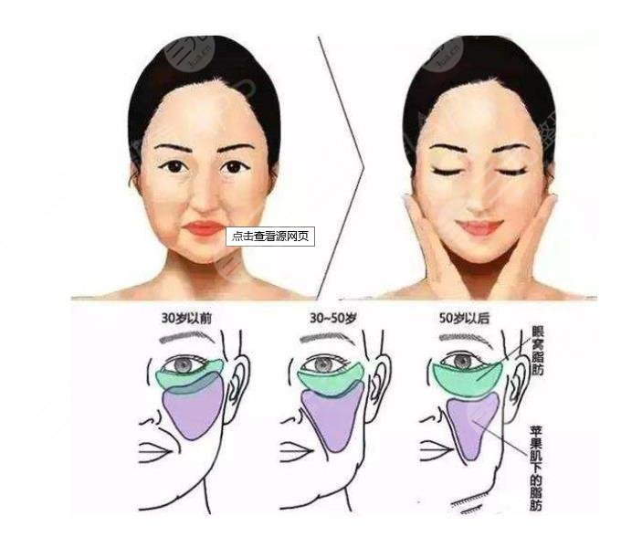 v美減齡后遺癥|輕微浮腫別擔(dān)心!手術(shù)原理+術(shù)后護理盤點~