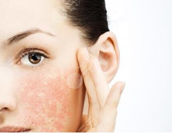 v美減齡后遺癥|輕微浮腫別擔(dān)心!手術(shù)原理+術(shù)后護理盤點~