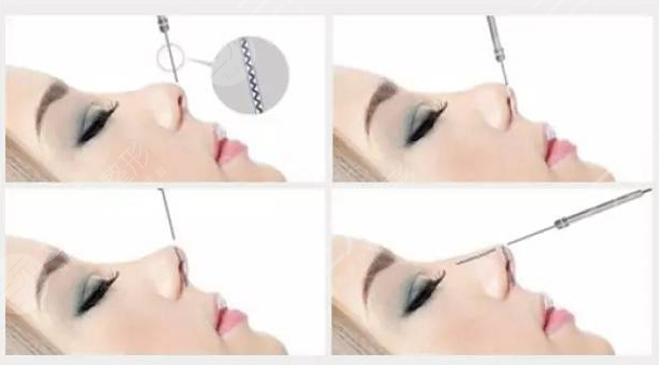 昆山達(dá)拉斯劉波隆鼻術(shù)后3天