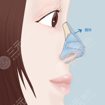 昆山達(dá)拉斯劉波肋軟骨隆鼻案例