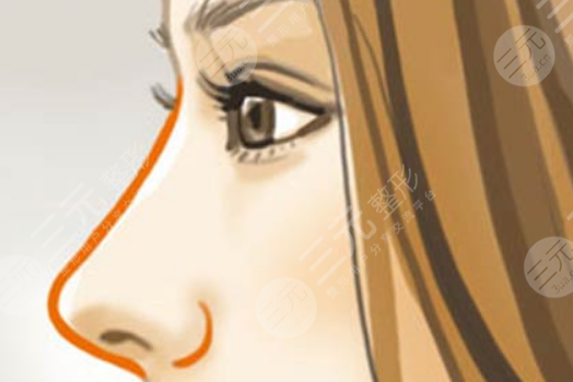 昆山達(dá)拉斯劉波肋軟骨鼻部手術(shù)案例