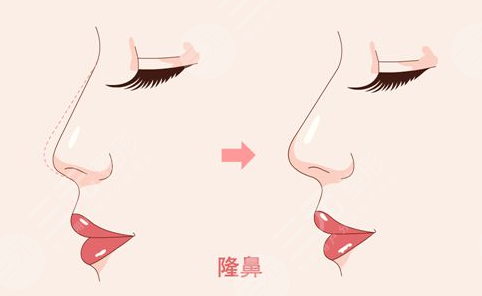 武漢肋骨鼻劉波