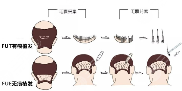 合肥叢生植發(fā)醫(yī)院頭發(fā)加密手術(shù)分享
