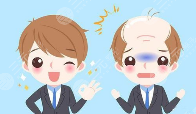 上海九院植發(fā)劉清醫(yī)生案例分享