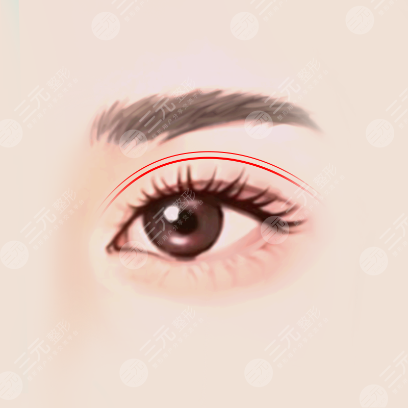 曹仁昌醫(yī)生雙眼皮修復(fù)案例果圖分享：術(shù)前