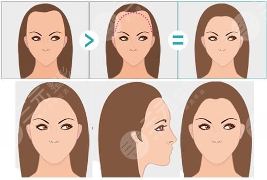 杭州時(shí)光種植發(fā)際線的案例果分享