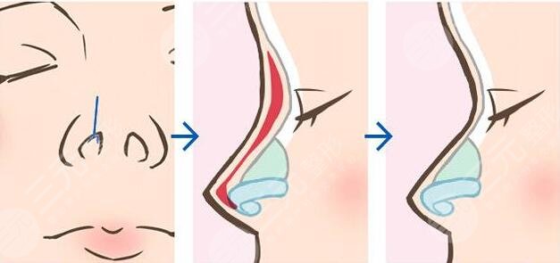 八大處范飛做鼻子案例前