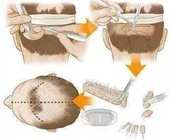 珠海雍禾植發(fā)醫(yī)院禿頂植發(fā)案例分享