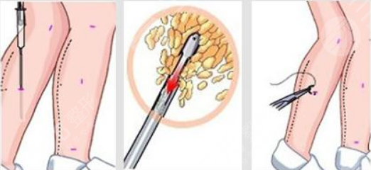 北京佰嘉利醫(yī)療美容吸脂瘦大腿案例
