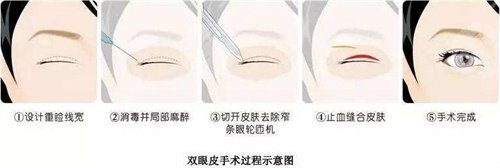 嘉興榮軍醫(yī)院美容科祛眼袋案例后